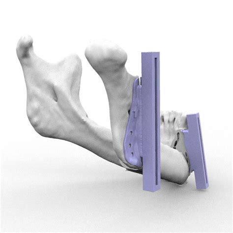 Maxillofacial Reconstruction Resection Guide Rmp Kune Implants