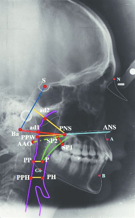 Cephalometric Landmarks S Sella Point Representing The Midpoint Of