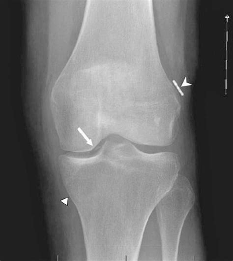 A Ap Knee View Significant Soft Tissue Swelling Is Observed At The Download Scientific Diagram