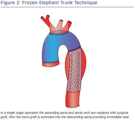 Figure 2: Frozen Elephant Trunk Technique | Radcliffe Vascular