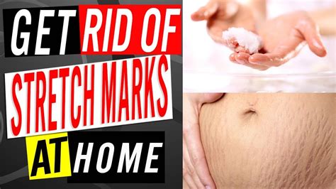 How To Get Rid Of Stretch Marks Naturally And Fast Effective Ways To