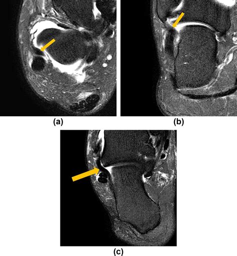 Usefulness of the oblique coronal plane in ankle MRI of the