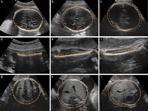 Evaluation Of Automated Tool For Twodimensional Fetal Biometry Salim