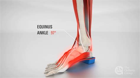 equinus ankle youtube