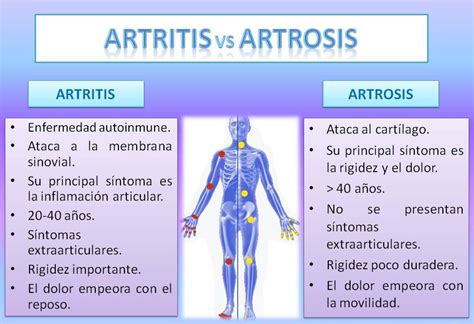 Diferencia Entre Artritis Y Artrosis