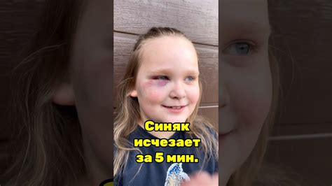 Как быстро избавиться от синяка на шее и убрать гематому