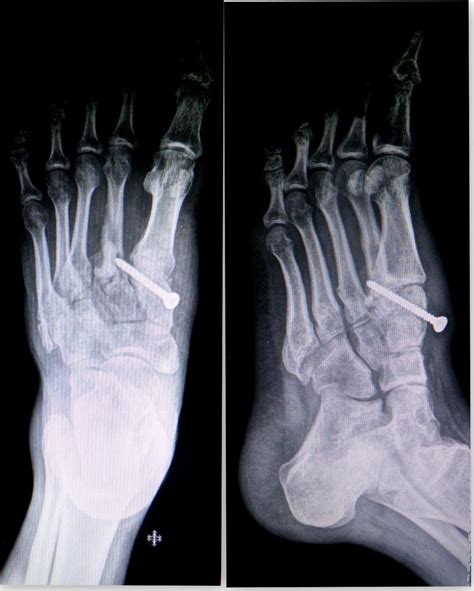 Divergent Lisfranc injury with dislocation of great toe interphalangeal joint: A rare case ...