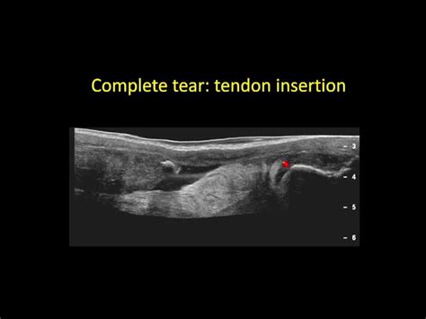 Quadriceps Tendon Ultrasound