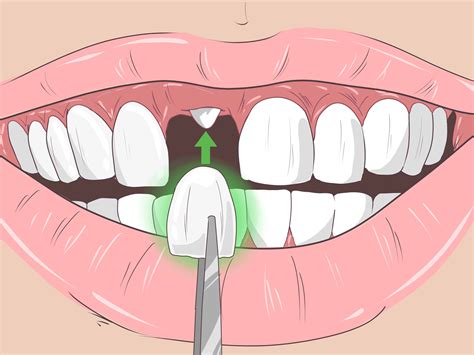 Brown Stains On Teeth After Wisdom Teeth Removal at Amy Dieter blog