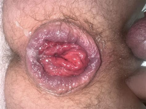 Anal Prolapse In Oxball Ff Pighole Nude Pics Xhamster
