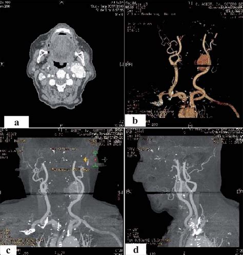 Angiografía Por Tac De Cabeza Y Cuello Con Reconstrucción Download