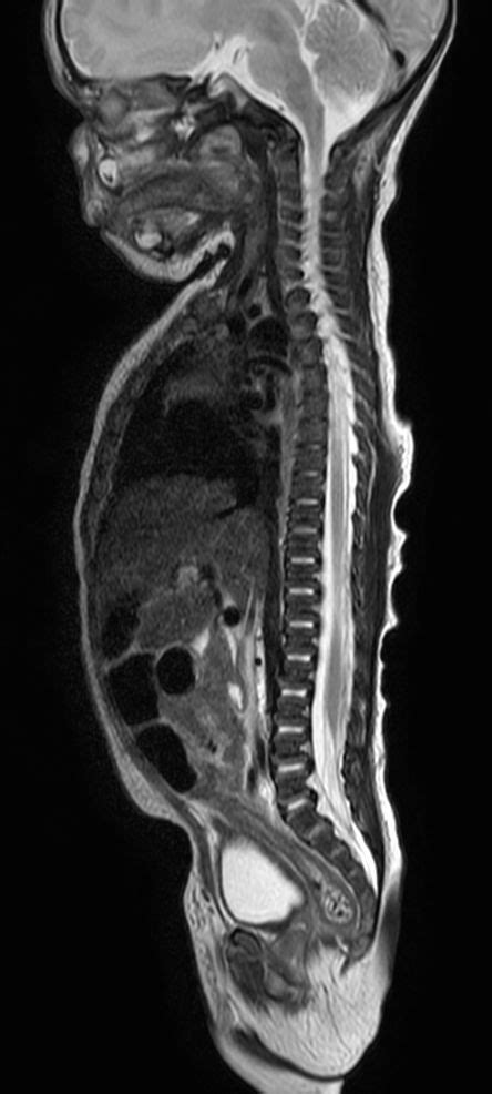 Pediatric Total Spine With Spina Bifida Philips Mr Body Map