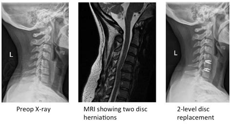 Artificial Cervical Disc Replacement - Samuel K. Cho, MD