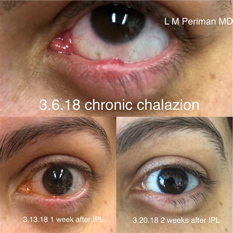 Chalazion Treatment