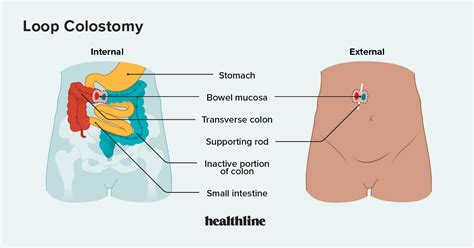 Loop Colostomy What You Should Know