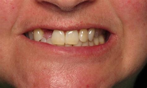 Before & After Photos | Dentures, Partials, and Bridges Gallery ...