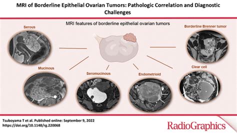 Mri Of Borderline Epithelial Ovarian Tumors Pathologic Correlation And