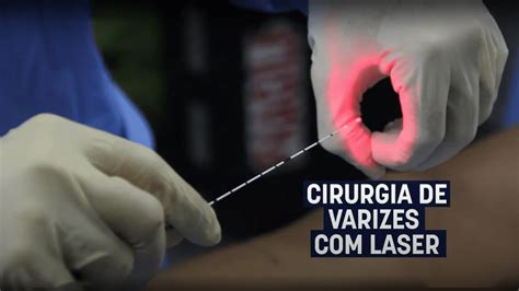 Cirurgia De Varizes Com Laser Dr Rodrigo