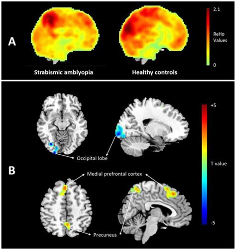 Altered Spontaneous Brain Activity In Patients With Strabismic