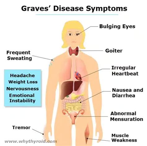 Graves Disease Causes Symptoms Diagnosis Treatment Why Thyroid