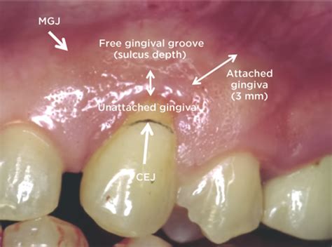 Miller Classification Of Marginal Tissue Recession Revisited After