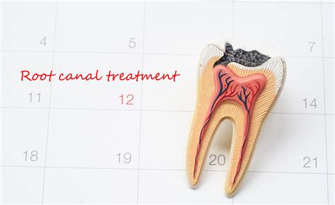 Root Canal Procedure Who Performs It And What Does It Cost