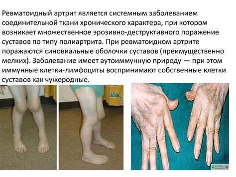 Ревматоидный артрит - презентация онлайн