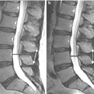 Fast Spin Echo Fse T Weighted Magnetic Resonance Images Mri In The