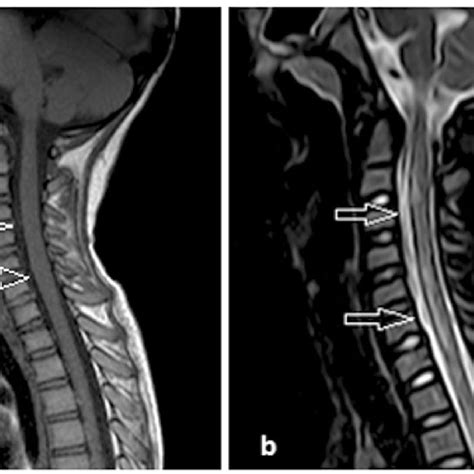 Mri Demonstrates Multiple Segments Of Signal Alteration Are Seen Within Download Scientific