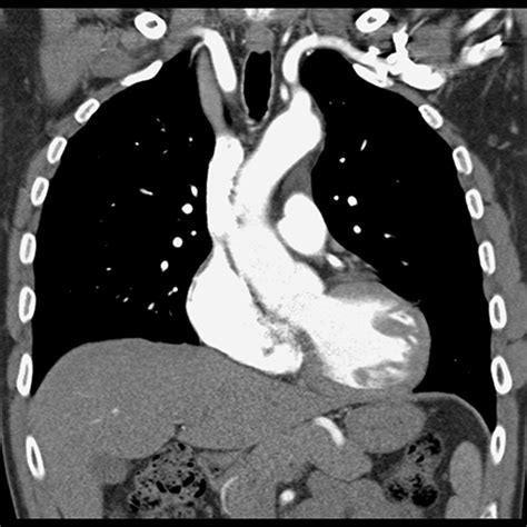 Coronal CT Angiography Mediastinal Window 1 Of 2