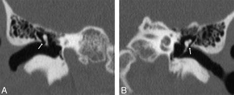 Prussak Space Ct Scan