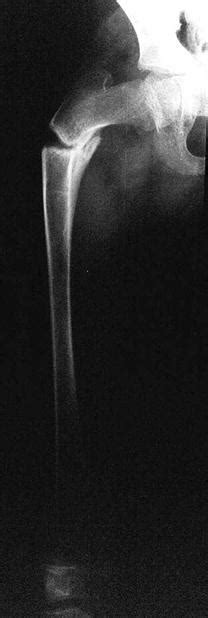 Congenital Bone Disorders Musculoskeletal Key