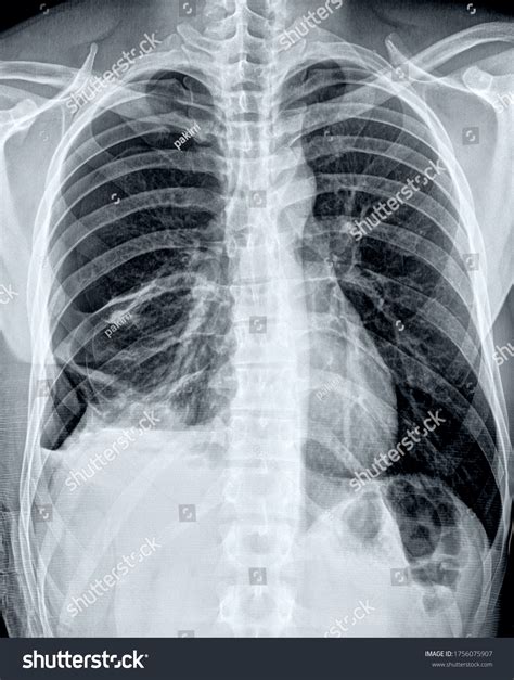 Chest X Ray Pneumonia Pleural Effusion at Glenda Rutkowski blog