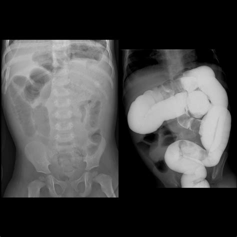 Distal Intestinal Obstruction Syndrome | Pediatric Radiology Reference