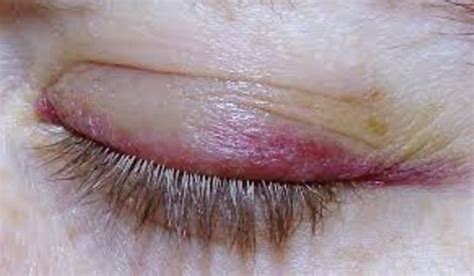 rash on eyelids - pictures, photos