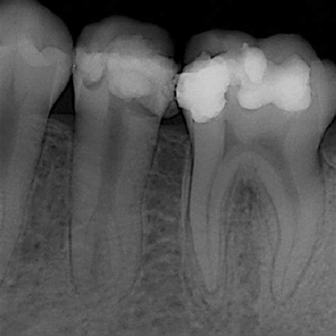 Preoperative Radiograph Download Scientific Diagram