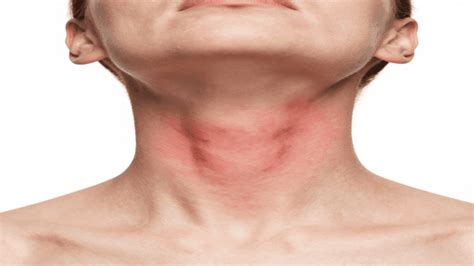 Itchy Rash On Neck Causes Symptoms Treatment And Prevention Guide