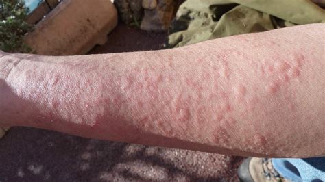 Hives Characteristic And Causes