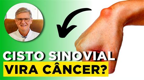 TUDO sobre CISTO SINOVIAL Caroço no Pulso Simplificando Ortopedia