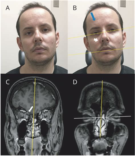 Pearls And Oy Sters Paradoxical Head Tilt In A Congenital Fourth Nerve