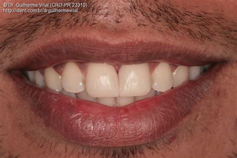 Fechamento De Diastema Com Resina Composta Caso Clínico Ident