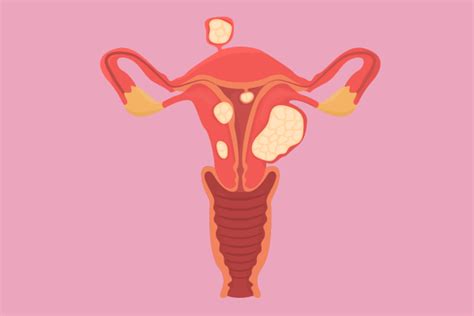 Identifying the Symptoms of Fibroids - The Parent Gadget