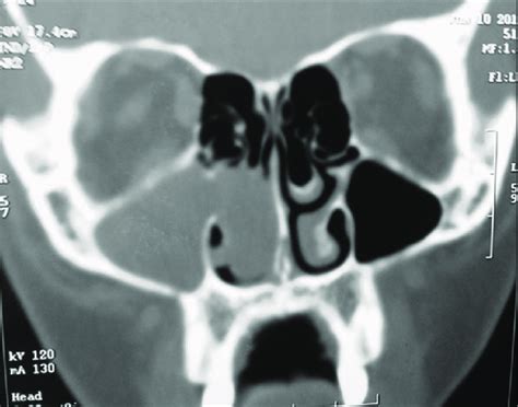 CT scan of the paranasal sinus showing opacification of the right... | Download Scientific Diagram