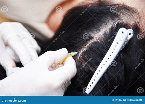 Psoriasis Hairy Part Of The Head Plasma Injection Treatment Of