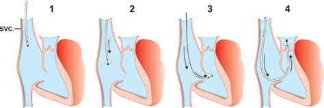 Right Heart Catheterization Thoracic Key