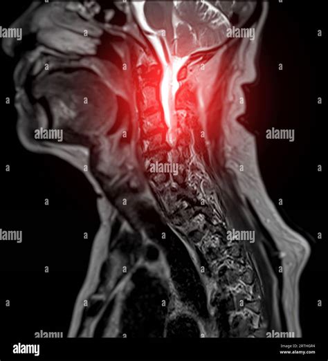 Cervical Myelopathy Mri