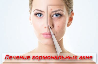 Лечение акне - как развивается болезнь, схемы лечения