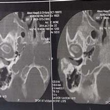 (PDF) Mastoid Osteoma: Report of An Unusual Case