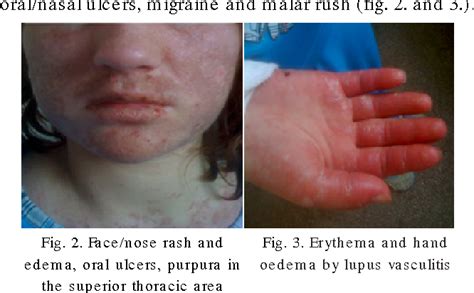 Nasal Ulcers Lupus