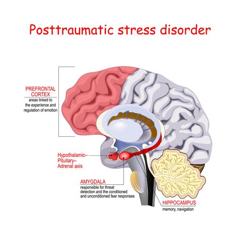 Hypnotherapy For Ptsd Why Consider It Hemisphere Hypnotherapy